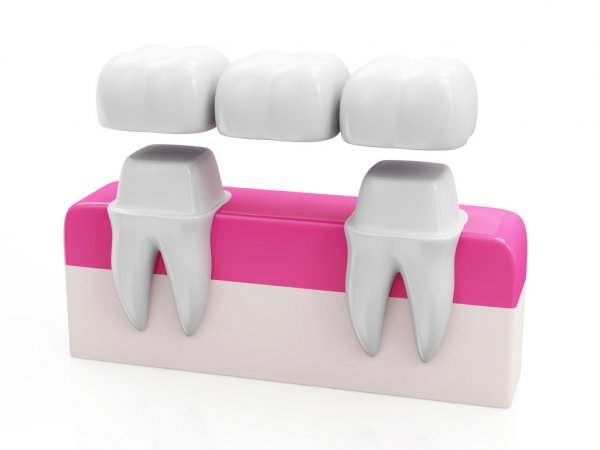 depositphotos_49475225-stock-photo-dental-bridge-concept.jpg