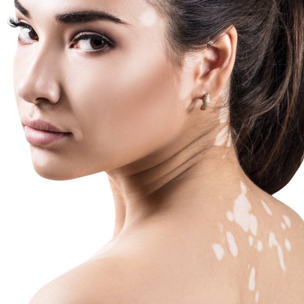 vitiligo.jpg